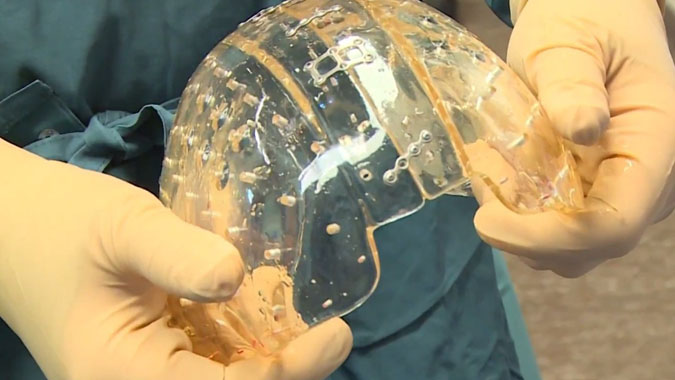 Des chirurgiens implantent un crâne imprimé en 3D