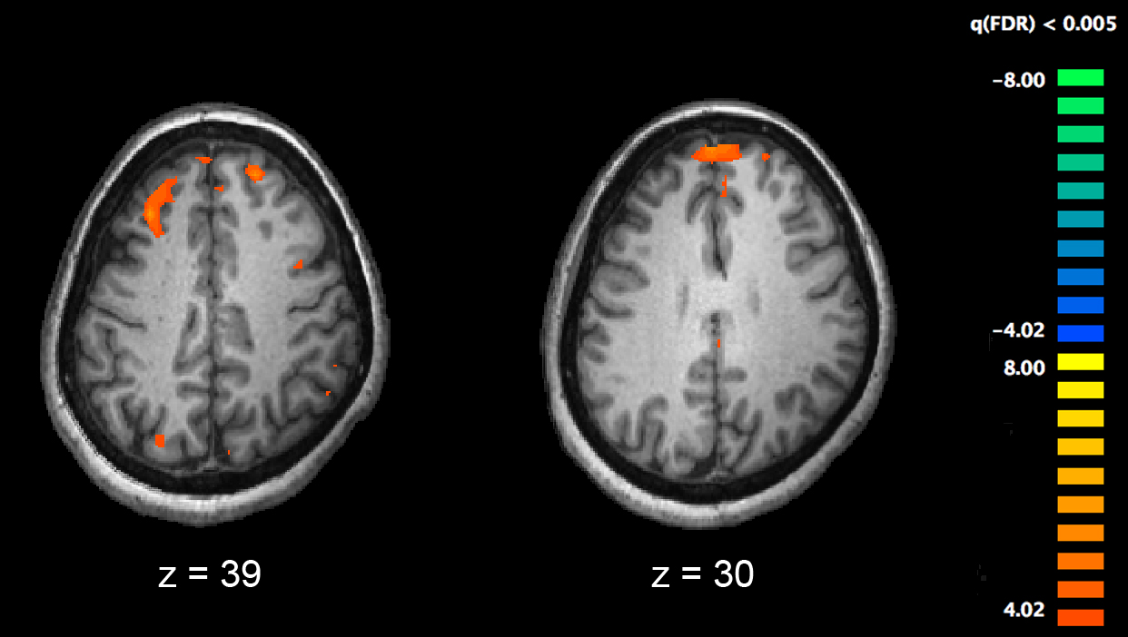 Ces chercheurs ont réussi à annuler un symptôme de la schizophrénie jusqu'ici intraitable