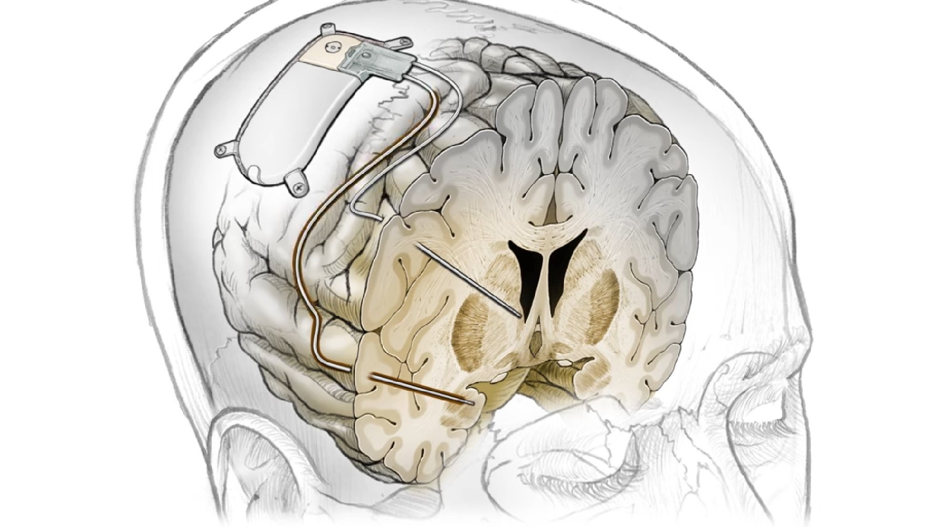 Resistant Depression Brain Implant Proven For The First Time thumbnail